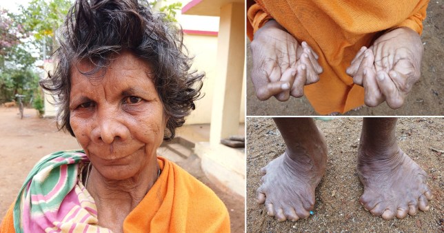 Women with 31 fingers called a witch throughout her life