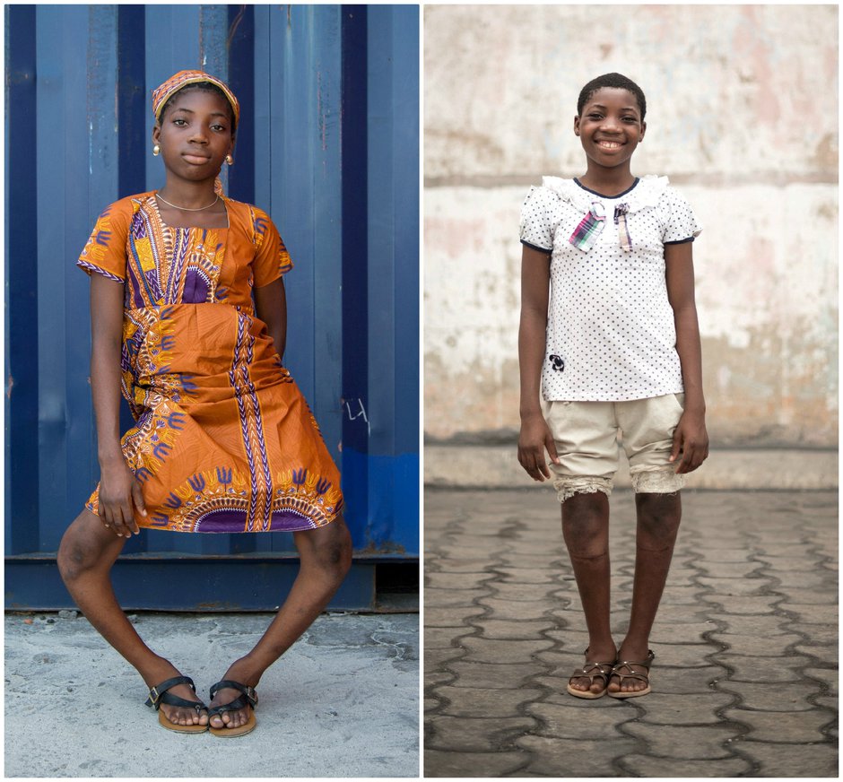 A girl in with bowleg deformity returns to school after free corrective surgery