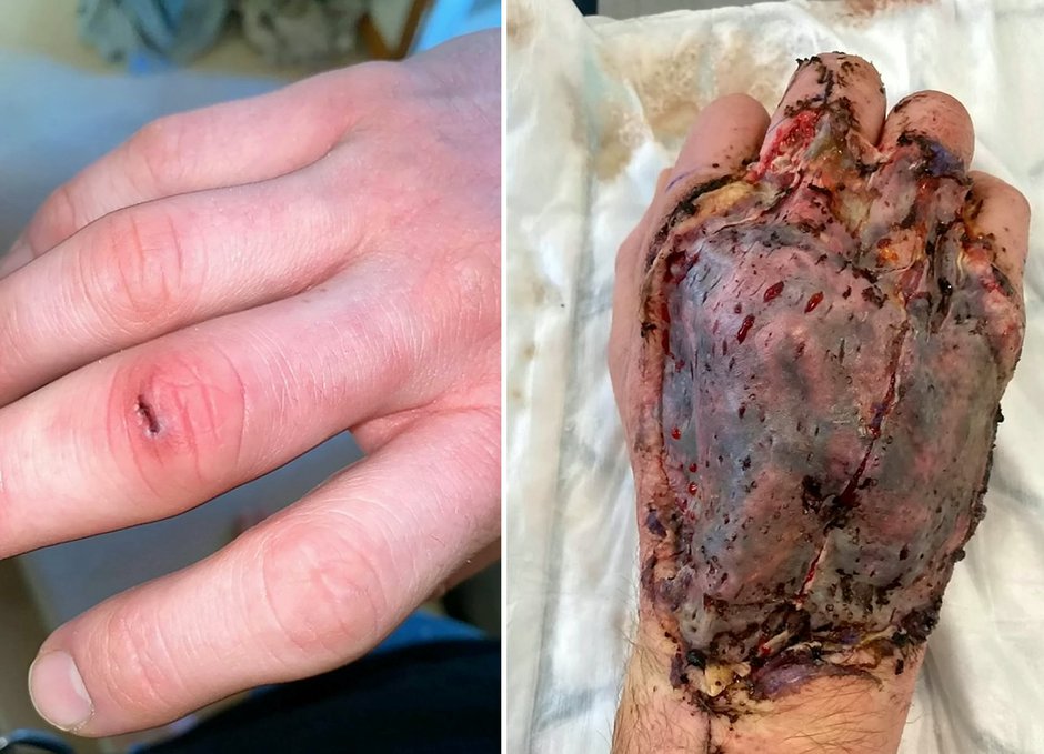 Garden horror: Father of two almost died of gardening when a flesh eating bacteria infected his finger
