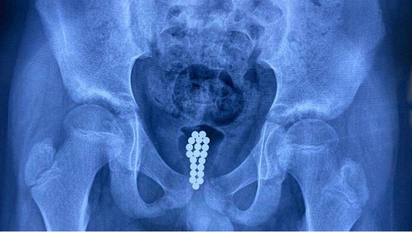Curious Chinese teenager inserted magnetic balls in his penis had to get his bladder removed
